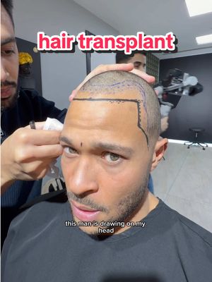 it’s about to go down 💉 #hair #turkey🇹🇷 #transformation #bald 