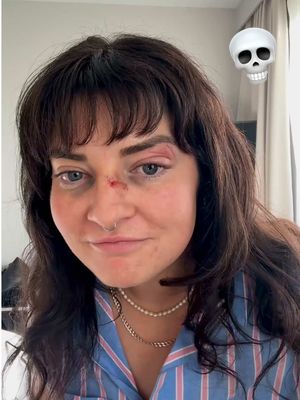 starting 2026 off with a literal bang (my body slamming the concrete)💀 before you comment, do not tell me what i did right or wrong/ do not comment any hate or dumb disrespectful things. you don’t know until it happens to you. i travel almost full time and this has never happened to me. all that matters is that im okay and this is the first time this has ever happened ! I am totally okay and this is unfortunately what this man chose as his mission for last night. i will continue posting as normal but obviously wanted to address this to make sure i wasn’t randomly posting with a black eye all of a sudden. thank you for all the nice messages and my year will hopefully only go up from here lol 🤠 