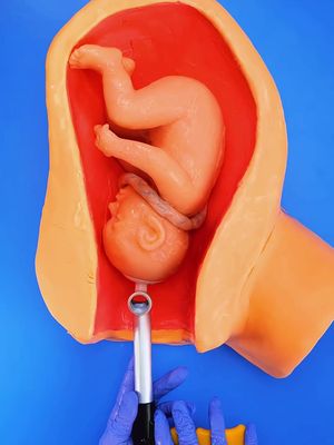 A complex delivery maneuver: Navigating A Nuchal Cord #birth 