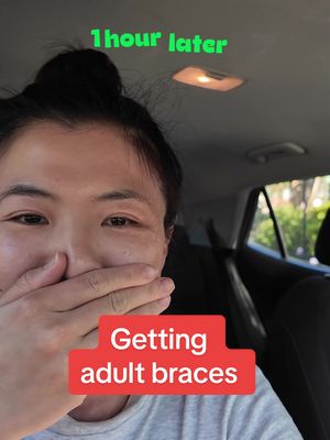 I’m 32 and I just got braces 🤪 It’s going to be a year of braces then a jaw surgery and then another year of braces, to fix my underbite. It’s a major operation so I’ve thought on it for 10 years and watched my younger sister go through the pain of the same surgery.  Hoping it fixes a lot of problems including my speaking (my most important tool!) and side profile. Lucky I’m a comedian so there will be plenty of material in this 😆  #adultbraces #orthodontics #braces #teeth 