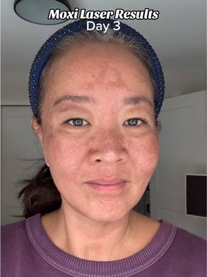 MOXI LASER! Here are my 7-day Moxi Laser results. Took me a month+ to be brave enough to post this, but I’ve been loving my no-makeup skin ever since! Why I decided to do Moxi laser: My melasma got so aggravated after a trip to Aruba plus being on perimenopause HRT has not helped keep it at bay. I also wanted brightening and to boost my over 40 aging skin texture for collagen renewal.  Want to see and learn more? Please leave some love in the comments so I work my courage up for round two Moxi + BBL lasers on Tuesday! 😬 Feel free to ask me anything!  #moxilaser #lasertreatments #skintransformation #melasma #darkspots 