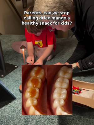 Just because it’s fruit doesn’t mean it won’t cause cavities. Dried fruit is often WORSE than candy because of how it sticks in the grooves of the molars like in this diagram. As a dentist who practiced for over 40+ years this is often the piece of advice I give that shocks parents the most. 👉For more advice like this, follow + comment NEWSLETTER - you’ll get the same advice my patients got for free, along with 115,000 others.
