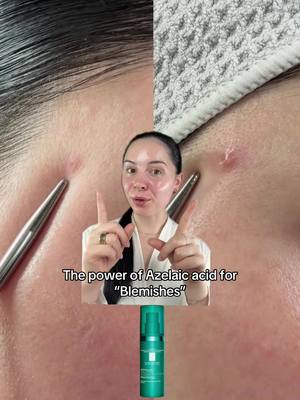The power of Azelaic Acid for blemish, The 7 day results done lie 👏🏻 @larocheposay Effaclar A.Z Gel-Cream gently exfoliates to reduce blemishes with immediate hydration 💧 AD effalcar #Azelaicacid #ad #Skincare #LaRochePosay 