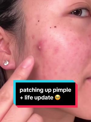 pimple patch + life update 🥹 #acne #skincare #pimplepatch #pimplepatchpeel @PeaceOutSkincare @Tower 28 Beauty @SKIN1004 US @Dr.Althea Official @InMyEyes 