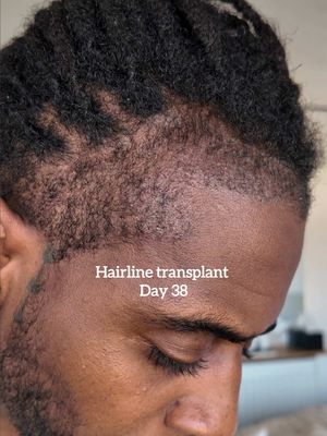 Hairline transplant with Locs is low key a hack 👀 I’ve got a few methods that have helped my hair grow back in quickly which I’ll share but any questions in the meantime, hit me below!