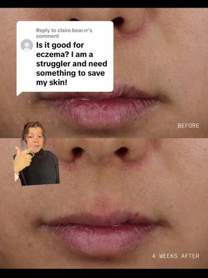 Replying to @claire.bear.rr #greenscreen Designed for all skin types, including dry, sensitive, and eczema-prone, Skin Mercy Recovery Cream is clinically proven to provide powerful relief from redness, itch, and irritation while deeply hydrating skin. Formulated with 1% colloidal oatmeal, an FDA-approved skin protectant, that works alongside our Soothing Complex to calm the skin. Glycerin attracts and retains moisture for natural bounce, while licorice root helps defend against environmental and age-related stressors. Awarded the National Eczema Association Seal of Acceptance, this silky-soft cream envelops skin in a protective cocoon of moisture, delivering lasting comfort and less reactive skin over time. This formula is vegan, non-comedogenic, non-acnegenic, non-sensitizing, fragrance-free, and ophthalmologist-tested. #moisturizer #skincarefordryskin #eczema #eczematreatment 