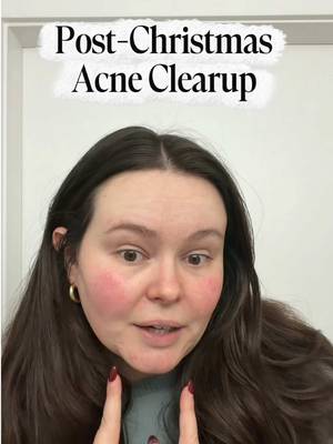 Update on my post Christmas acne clear up! There’s progress ☺️🤍🫶🏻 Everything linked in bio! #acne #acneskin #acneproducts #cysticacne #hormonalacne 