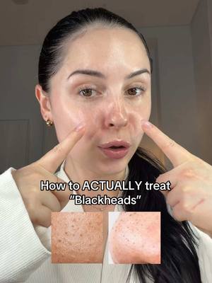 Did you know Azelaic Acid can help with blackheads? It helps unclog pores, smooth texture & support clearer looking skin 🤍 @azclear Medicated Lotion is available at @chemistwarehouse & @pricelineau Ad.