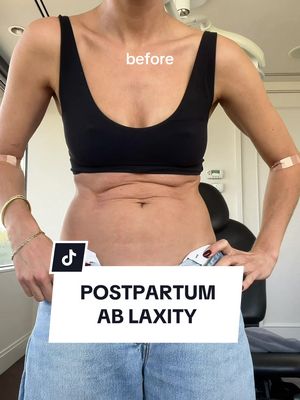 This wasn’t about weight or “bouncing back.” I don’t want to erase birth or what my body has been through - it’s about skin quality and how that thinner, looser, crepey skin can linger long after weight loss or pregnancy. I did 2 treatments with @Dr. Katie 👩🏻‍⚕️Dermatologist and documented the entire thing:  I. Ultherapy 2.Sculptra Here I’m showing a real before and after over 3 months: subtle, gradual, and realistic - which is exactly how collagen works. I’m sharing this because I couldn’t find many honest, in-between timelines that weren’t a miracle claim or a warning story. If you’re navigating postpartum skin changes, I hope this gives you clearer expectations and better context. Let me know if you want an update in 6 months!