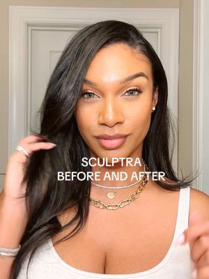 Sculptra Before and After - done by @JordanDupreeInject @The Swan Center  My treatment was done in November. Sculptra stimulates your body’s own collagen for natural-looking results over time and can last up to two years. My last Sculptra treatment was three years ago, and I’ve been obsessed ever since.  #sculptra #sculptrabeforeandafter #medspa #skincareroutine 