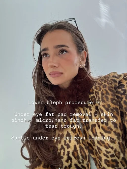 A few weeks ago did a lower bleph & small skin pinch / fat pad removal / transfer to finally address the under-eye area that’s bothered me for years. The first week was bruised and puffy and very unglamorous. But now? I’m obsessed. It’s subtle, but the tear trough area is so smooth and seamless and I genuinely feel more rested and confident every time I look in the mirror. This wasn't about changing my face - just finally fixing something that never felt like me. And @drirasavetsky - you are a king - there is no one I would recommend or trust more to do this with. Still healing but already beyond happy with the results!!! Lower Bleph Procedure Under Eye Fat Pad Removal