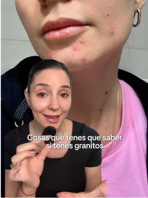 Cosas que tenes que saber si tenes granitos, te doy mi super tip! #parcheinvisibleresultadovisible #pimplepatchresults #acne #garnier #skincare 