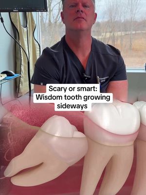 Wisdom tooth growing sideways! Content purposes only for education. #fyp #wisdomteeth 