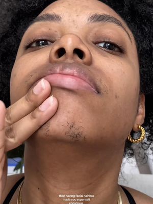 The girls have been telling me to try laser and this year is all about taking leaps so here I am, first session ✅ #laserhairremovalnyc #medspanyc #facialhairremovalforwomen #facialhairgrowth 