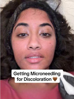 Replying to @youngbloodartistry Dealing with adult acne has been such an emotional struggle for me. After changing up my skincare routine for the past few weeks, I’m getting microneedling done to help with dark spots and hyperpigmentation on my brown skin 🥲  #microneedling #darkspots #hyperpigmentation #adultacne #browngirl 