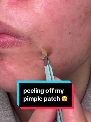 Replying to @PeaceOutSkincare wow that was a JUICY peel 🙂‍↕️ #acne #pimplepatch #skincare @PeaceOutSkincare @Tower 28 Beauty @Easyderm 