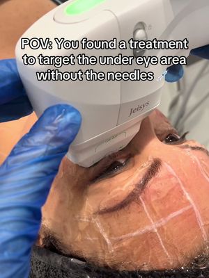 HIFU - works by stimulating new collagen and elastin around the delicate eye area. No Needles, No lasers.  The results!?  Improvement in skin texture , reduction of puffiness and bags under the eyes , reduction of fine lines and wrinkles.  #eyes #facelift #hifu #BeautyTok 