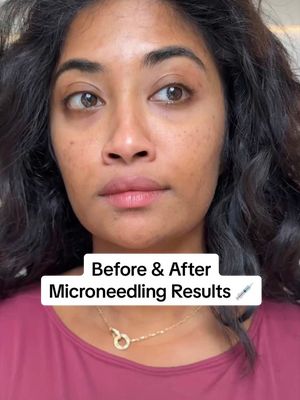 Replying to @yarah048 THE 2 MONTH END RESULTS THOUGH 👀 My before and after of microneedling results on brown skin 🤎 Second round will be coming soon! #microneedling #darkspots #adultacne #browngirl #skincare  