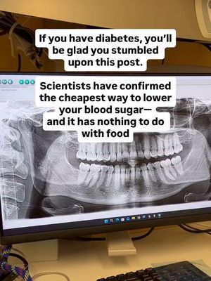 A Cochrane Review — the gold standard of medical evidence — analyzed 35 randomized controlled trials and over 3,000 patients. The finding: treating periodontal disease reduced HbA1c by nearly half a point in people with type 2 diabetes. No new medication. No dietary intervention. Just treating the infection in their mouth. Here’s why that happens… Gum disease is a chronic bacterial infection that triggers a systemic immune response — meaning your body is fighting inflammation around the clock. That constant inflammatory load directly impairs insulin signaling and disrupts your body’s ability to regulate glucose. Remove the infection. Reduce the inflammation. Improve blood sugar control. The same mechanism that connects gum disease to heart disease, Alzheimer’s risk, and preterm birth. To be clear: treating your gums is not a replacement for diabetes management. But the evidence is now strong enough that I believe every endocrinologist treating a diabetic patient should be asking: when did you last see a dentist? And every dentist treating a patient with bleeding gums should be asking: has anyone checked your blood sugar? We’ve siloed these two conditions for too long. If you have type 2 diabetes and you’ve never had a full periodontal assessment — not just a cleaning, a full assessment with pocket depth measurements — that conversation needs to happen. If your dentist isn’t talking to you about stuff like this, welcome. I’m a dentist who practiced for nearly 40 years sharing wisdom like this on my page — follow along and comment NEWSLETTER to join 126,000 people getting info like this for free. 📎 Sanz et al., Cochrane Database of Systematic Reviews, 2022. PMID: 35420698