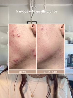 Breaking down why Rescue Serum was made and all of the incredible benefits it has for common skin concerns like acne, pigmentation, post-acne marks and so much more #acnetreatment #azelaicacid #acneproneskin #acnejourney #acnetips @ben 