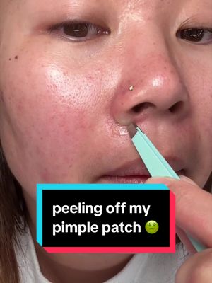 i havent had a super juicy peel in a while 🫣 #pimplepatch #acne #skincare #pimplepatchpeel @PanOxyl @Tower 28 Beauty 