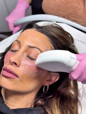 Our RHORI queen 🐰 @Aliciac143  #rhori #sofwave #lipbunny #alicia #skintightening 