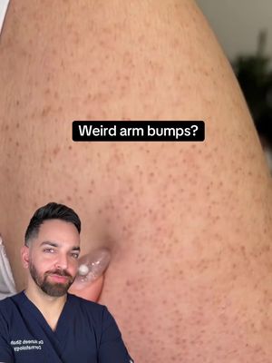 Weird arm bumps? #remedy #kp #keratosis #strawberryskin 
