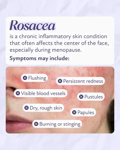 In honor of Women’s Health and Skin Protection Month, we’re spotlighting rosacea. While treatment varies based on subtype and severity, it often includes a combination of gentle skincare, targeted therapies, and, in some cases, hormone replacement therapy (HRT).  There are also simple lifestyle changes you can start today to help manage symptoms: 🫧Identify and avoid triggers 🫧Use fragrance-free products 🫧Protect your skin daily with broad-spectrum SPF  To learn more about supporting your long-term skin health, comment “journal” and we’ll send you a link to the Winona Menopause Journal. #skinhealth #womenshealth #agingskin #estrogenloss #hormonehealth