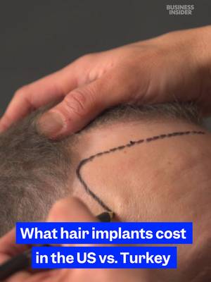 Here's what a hair #transplant costs in #Turkey vs. the US. #hairtransplant #hairloss  #hairlosstreatment