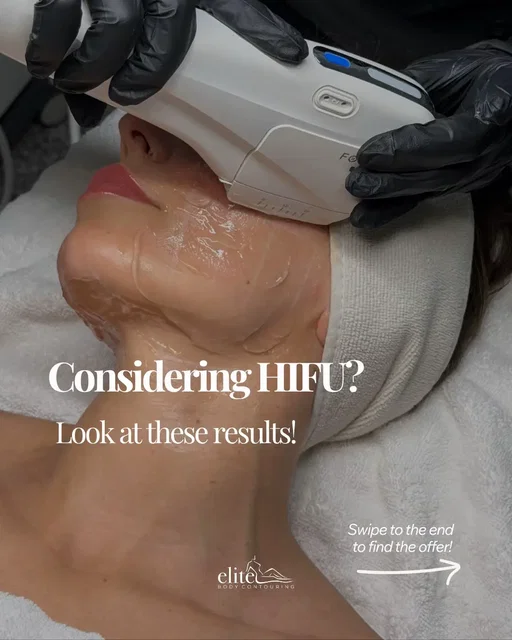 ⏳ Only 24 hours left to save on HIFU Face & Neck! Get an extra $75 OFF with code 75OFF in conjunction with our 50% OFF sale ✨ HIFU uses High-Intensity Focused Ultrasound to help lift and tighten the face and neck by stimulating collagen deep beneath the skin with no surgery or downtime. ✅ TGA-approved technology ✅ Supports skin tightening + lifting ✅ Walk in, walk out treatment ✅ Results continue developing over 4–12 weeks 🔗 Book via link in bio 📍 18 clinics across NSW, ACT & South Australia 🚨 Code 75OFF ends 14 May. *T&Cs Apply #HIFUFace #SkinTightening #NonSurgicalFacelift #JawlineContour #TikTokBeauty 