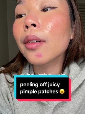 i need my skin to clear before i leave for my vacay in a few days 😩 #acne #skincare #pimplepatch #acneskincare @Easyderm 