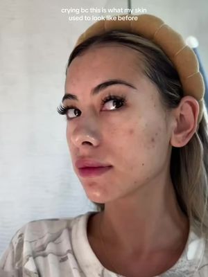 I can not believe I’m posting this… but to anyone struggling with acne out of nowhere & feeling helpless this is the ONLY thing that helped me and give me my confidence back!  Not sponsored at all - just genuinely trying to help anyone else 🤍  Current products : entire @reale actives routine, tretinoin every 3 days. Thank you @Alix Earle & @Dr. Kiran Mian 🤍🤍🤍 #tretinoin #realeactives #alixearle #acnejourney #skincarereview 