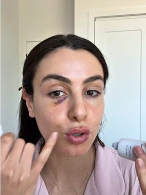 UN BLEU SUR L’ŒIL AVANT LA F1? 😩 C’est pour ça que je suis passionnée de maquillage, c’est juste fascinant!  Une note sur 10? ☺️ #fullcoverage  #makeup  #tarte  #tarteshapetape  #bruises    @tarte cosmetics  @Morphe Cosmetics  @Anastasia Beverly Hills  @Beautyblender  @Laura Mercier  @L’Oréal Paris  @sephoracanada  @Sephora Collection  @Summer Fridays  @Natasha Denona  @Diorbeauty  @rhode skin  @milkmakeup 