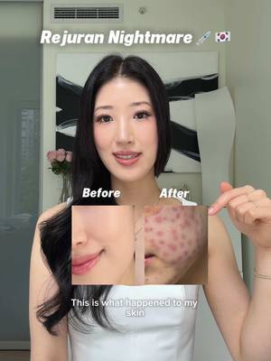 My nightmare Rejuran experience in Korea 💉🇰🇷 #rejuran #rejuranhealer #kskincare #koreanskintreatment 