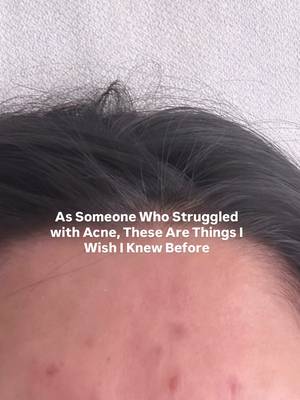 If you are struggling with acne read this 👇 Things I wish I knew before struggling with acne for years 🥲 Not all acne is actually acne, sometimes it’s fungal acne, and treating it like regular acne can make it worse Oil cleansers were triggering my skin more than helping it  Switching to fungal acne-safe products made a bigger difference than buying more skincare Keeping my routine simple helped my skin heal faster• you don’t need a 10 step routine Washing my face with just water in the morning actually helped calm my skin Over Exfoliating damaged my skin barrier and caused more breakouts Less products = less irritation sometimes I genuinely wish I learned this sooner because my skin improved so much faster once I simplified everything 🤍 #acne #fungalacne 