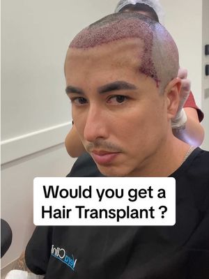 Hair Transplant Day 1-Month 22.  Would you get one?  #hairtransformation #hairtransplant #hairtransition #selfcareformen 
