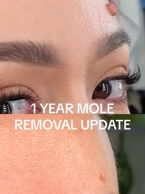 1 year mole removal update without makeup!! the other day, I made a video on the anniversary of removing the iconic alisha marie molina mole and emphasized how much it had grown. here’s an update without makeup, but if you’re thinking of doing this, do your research and make sure you’re going to a good dermatologist that your trust!! #dermatologist #skin #update #skincare 