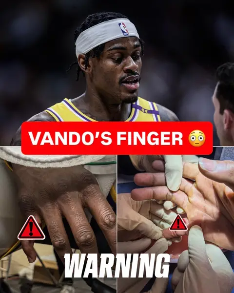 WARNING: Jared Vanderbilt shared photos of the finger injury he sustained during the 2026 NBA Playoffs. (via vando_vault/IG) #lakers #NBA #wild 