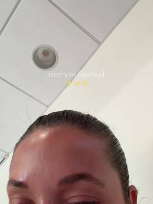 Lowkey giving fresh tox ✨✨ 11 weeks on tret!! #tretinoinjourney  #tretinoin #skincare #acneskincare 