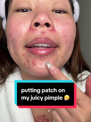 i need a restock on n these patches. thankfully theyre on sale for prime day 🤭 #pimplepatch #acne #skincare @Easyderm 