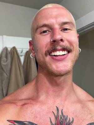 Bleach burn over a sunburn 
