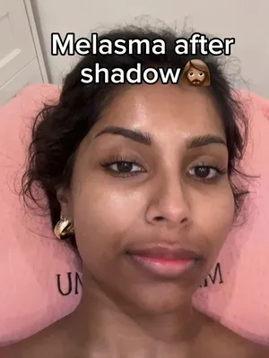 What nobody tells you about brown skin: • Melasma and hyperpigmentation are not the same thing and need completely different treatments • Your iron levels are showing up on your face right now • Korean SPF and Western SPF are not doing the same job • Your birth control could be making your melasma worse • You cannot out-serum a deficiency I learned all of this the hard way over 5 years as a South Asian PCOS girly with melasma and hyperpigmentation. Then I wrote a guide so you don’t have to. 🤎 ✦ 🔗 in b10 if you want it now ✦ Follow for more 🤎 #melasma #hyperpigmentation #brownskin #southasian #PCOSskin 