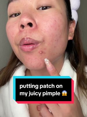 anyone else breakout on their chin every time their period comes 🫠 #acne #pimplepatch #skincare @Rodan and Fields @Easyderm @PURITO SEOUL @TIRTIR Inc. @Olehenriksen 
