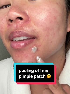 that was a 10/10 peel 🤩 #pimplepatch #acne #skincare  @Easyderm 