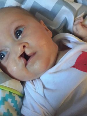 Update from Mila’s cleft appointment 💖