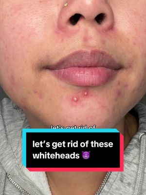 wow those were some juicy peels 🤩 #pimplepatch #acne #skincare #pimplepatchpeel @Rael 