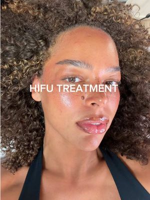 Ok so I HAD to try the HIFU treatment -  It is a focused ultrasound energy to heat deeper layers of the skin, stimulating collagen production. This can help tighten and firm the skin, improve elasticity, and reduce the appearance of fine lines without surgery. Pain - 4/10 Results aren’t properly visible till 3 months after treatment so I will keep you posted #hifu #beautytreameant #BeautyTok @aestheticsbynaomiriby  Thank you again for an amazing treatment and forever being so kind and gentle 🩷