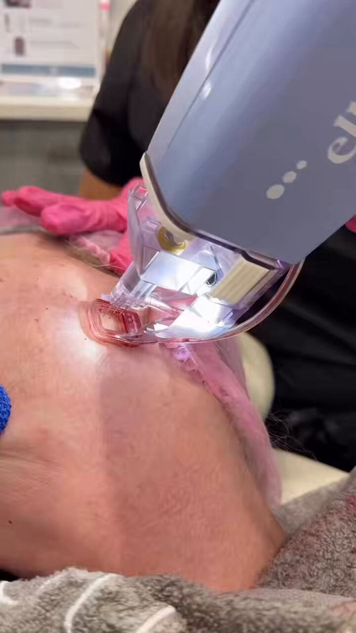 this is the first time i’ve seen a micro coring treatment it’s kinda crazy 😭 they’re literally taking tiny columns out of the skin. 

it’s basically like surgery but not really 