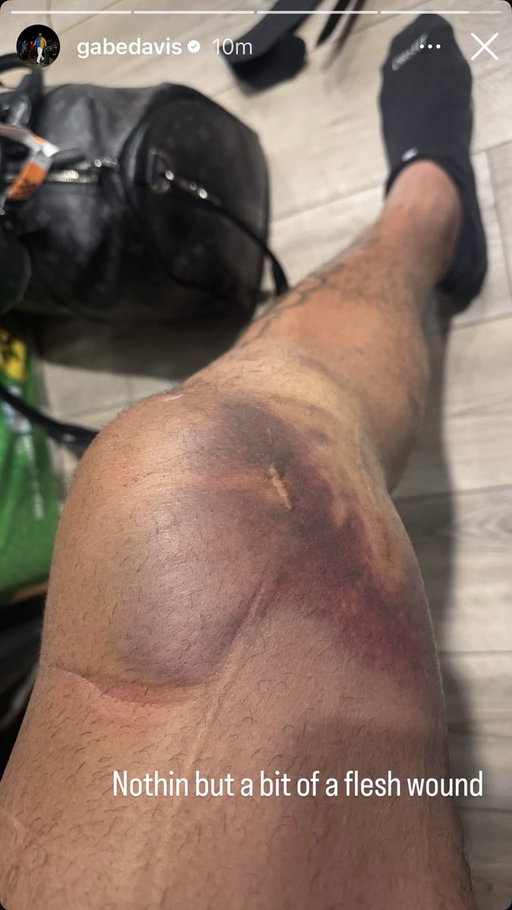 Gabe Davis posted his knee on instagram:

😳 
