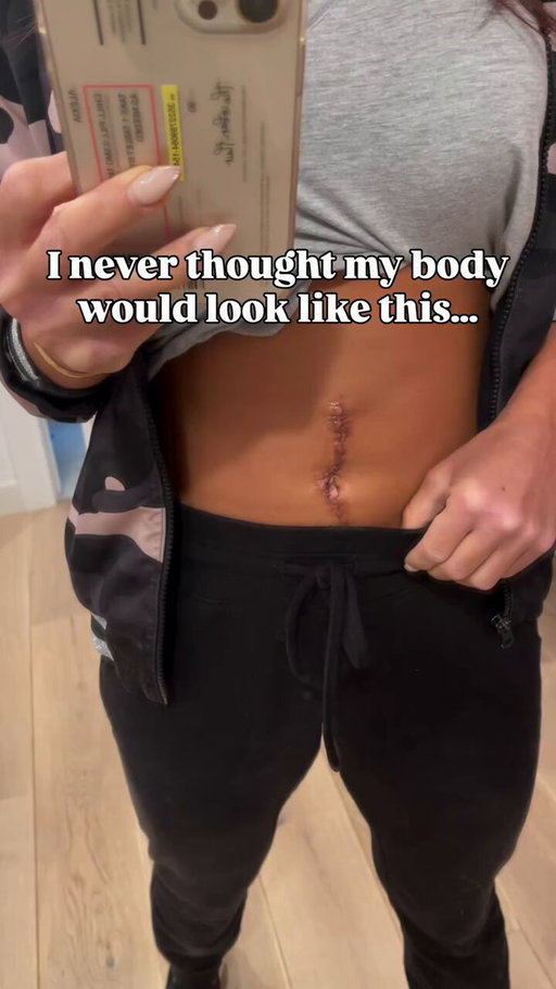 I never thought my body would look like this…

One day I was training like normal.
The next, I was being told I needed emergency surgery.

No warning. No control.

And yeah, there’s a scar. A big one.

But here’s the truth:
I don’t see it as something to hide.
I see it and I’m proud.
I see it as proof that I showed up, did the work,
and came back stronger than I was before.

This body isn’t what I had before.
It’s what I fought to rebuild.